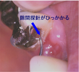 銀歯の中